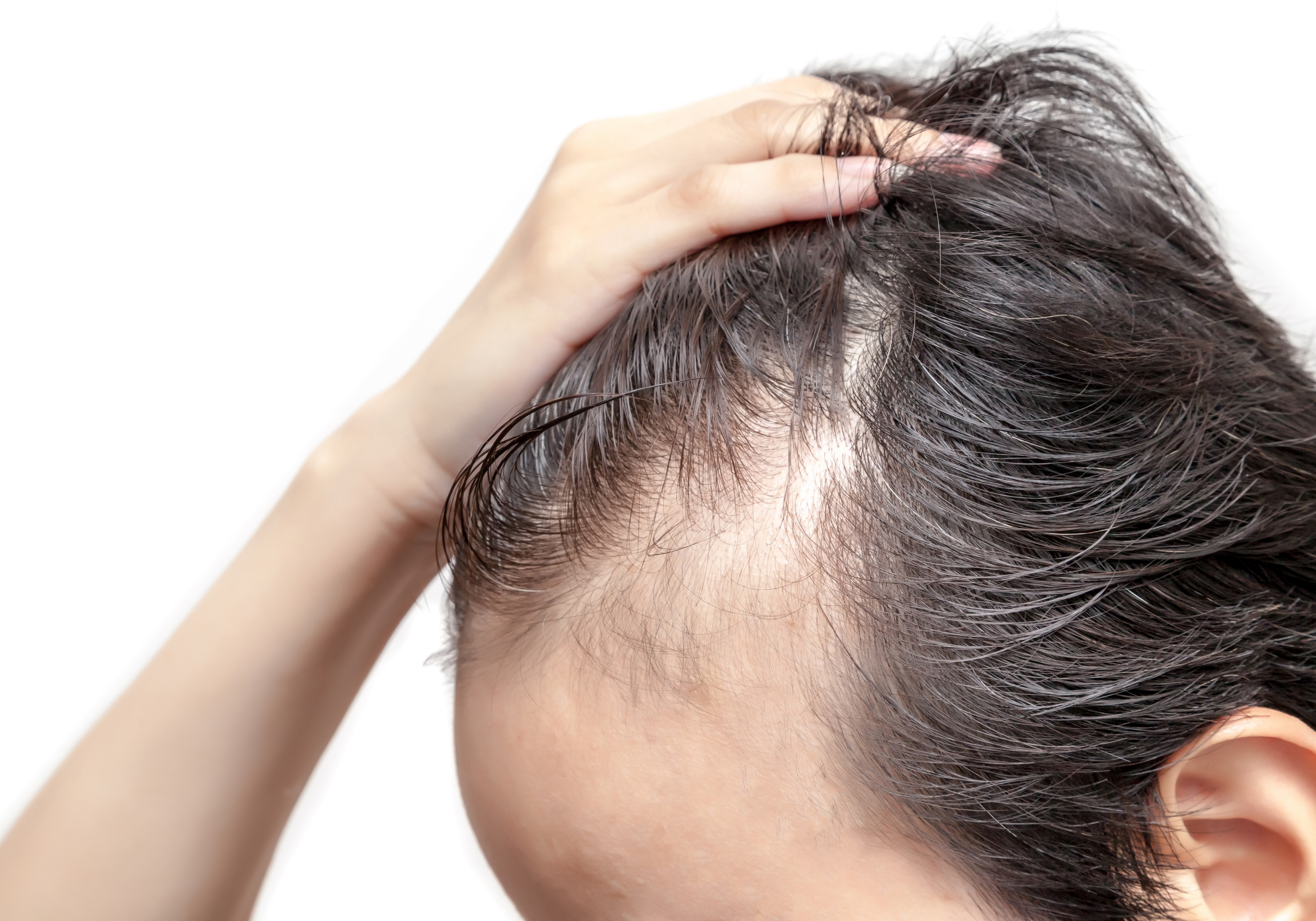 Łysienie androgenowe (AGA): przyczyny, objawy i skuteczne leczenie wypadania włosów